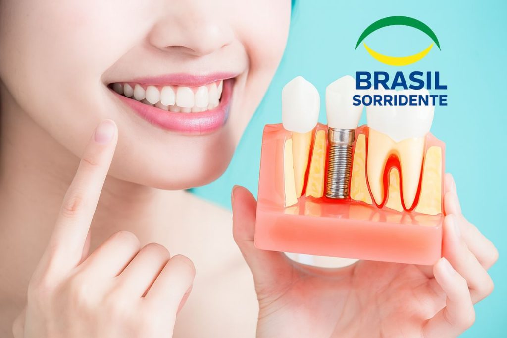 Implante Dentário Gratuito